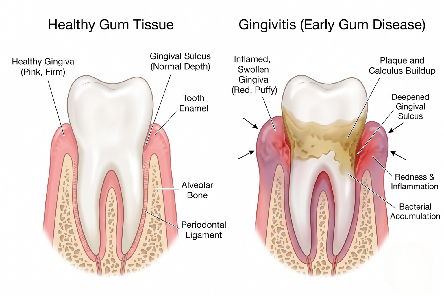 smile-lane-best-dentist-clinic-in-gingivitis-treatment-kolkata